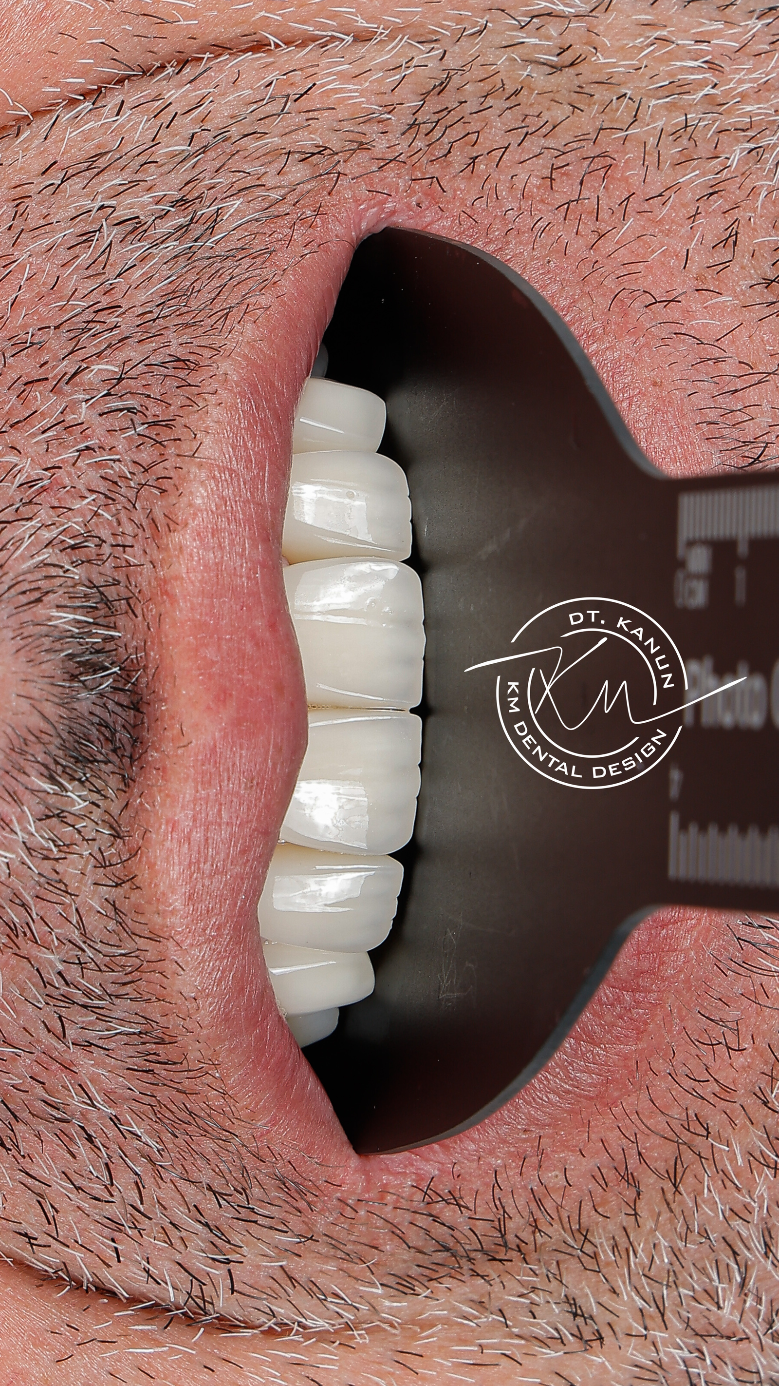 KM Dental Design - Before After 9